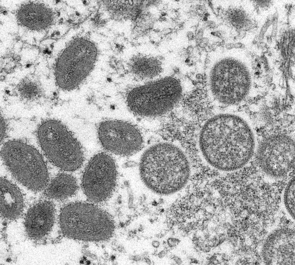 Premier cas de variole du singe