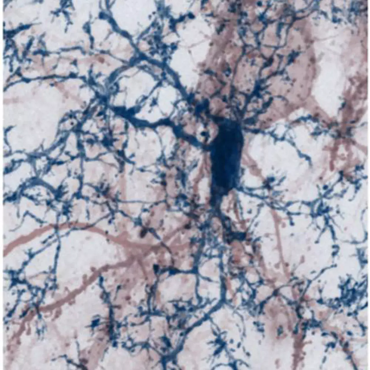 Combattre la sclérose en plaque - Article Panorama 2021