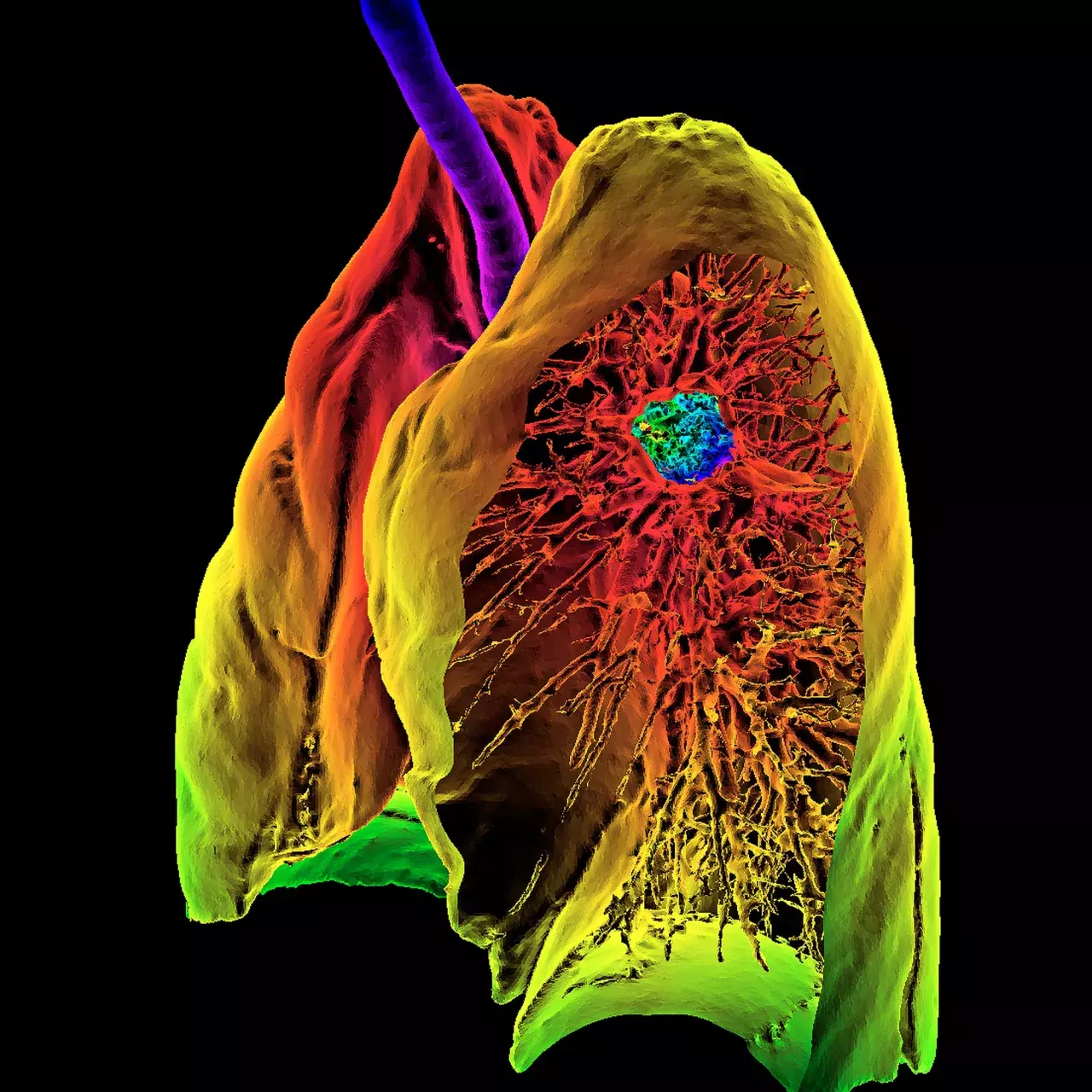 Un nouvel outil de pronostic du cancer poumon - Article Panorama 2021