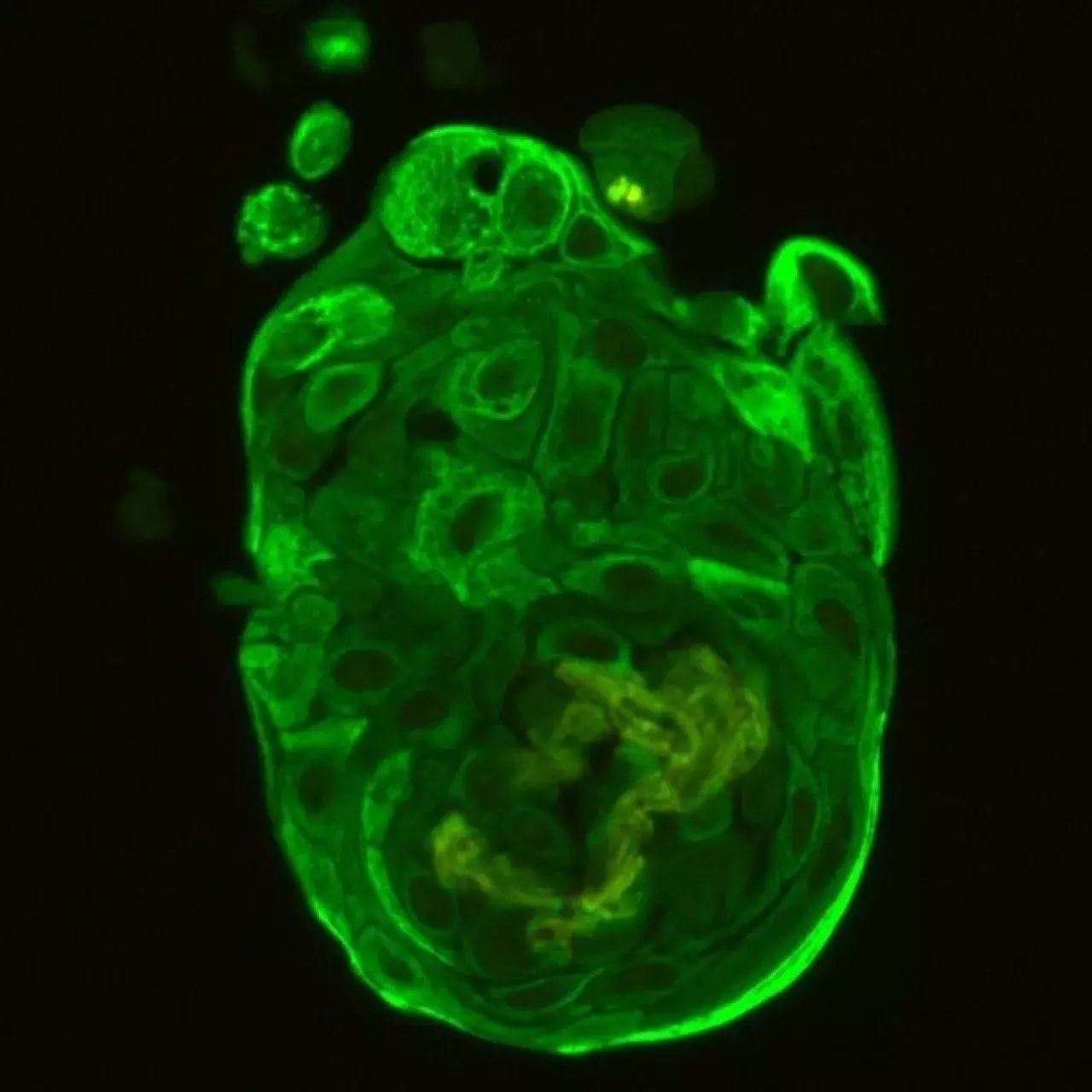 Chercher_Tumeurs pulmonaires