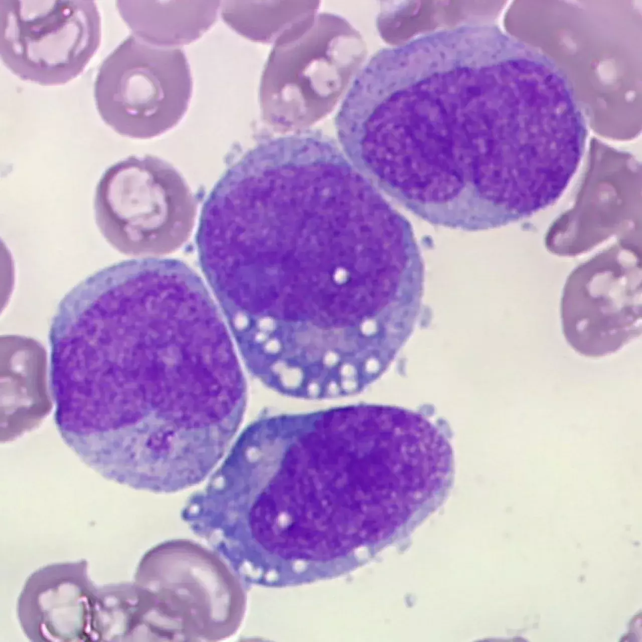 Leucémie cellules souches