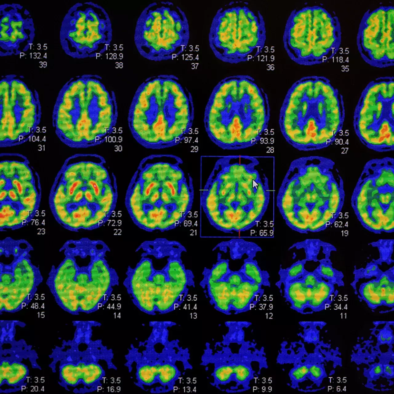 Consensus européen Alzheimer