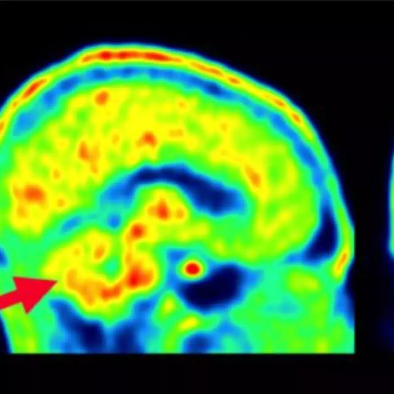 Chercher traceur inflamatoire